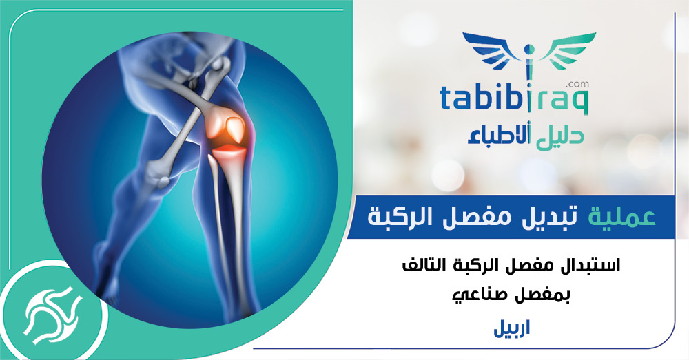 عملية تبديل مفصل الركبة في اربيل عملية تبديل مفصل الركبة في اربيل